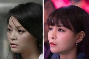 金晨鼻修复失败引热议：医美过度致面部抽搐